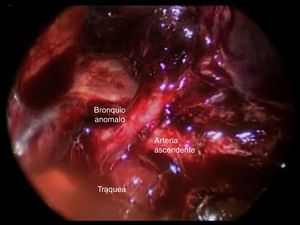 La disección posterior permite identificar la tráquea, el bronquio anómalo y la arteria ascendente del lóbulo superior.