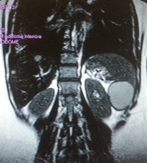 La imagen de resonancia magnética del abdomen (reconstrucción coronal) reveló un quiste septado que ocupa el polo inferior del bazo. La lesión fue de 6×4cm de diámetro y apareció hiperintensa en las imágenes potenciadas en T2, desplazando el parénquima esplénico restante (el llamado «signo pico»).