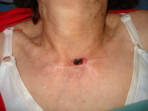 Carcinoma epidermoide invasivo en la base del cuello.