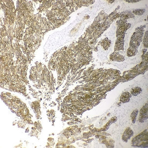 Expresión membranosa fuerte y completa del HER2(3+) en un adenocarcinoma intestinal poco diferenciado (inmunohistoquímica, x200).