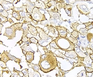 Análisis con inmunohistoquímica de la sobreexpresión del HER2(3+) en un carcinoma poco diferenciado con células en anillo de sello (x400).