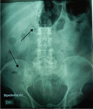 Radiografía simple de abdomen en bipedestación, la cual muestra poco gas intestinal, con un nivel hidroaéreo en el epigastrio probablemente en un segmento del colon transverso y una calcificación ovoidea, tenue, en la fosa iliaca derecha.