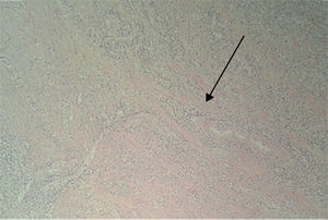 Estudio histopatológico (×10) que muestra la pared del apéndice cecal con infiltración por linfocitos en la capa muscular.
