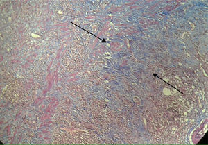 Estudio histopatológico (×40) con tinción tricrómica de Masson, la cual deja ver la presencia de fibrosis (color azul) entre las fibras musculares (color rojo) en el apéndice cecal.
