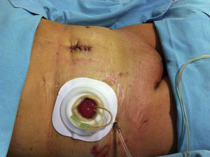 Resultado final de heridas quirúrgicas abdominales y estoma del conducto de Bricker.