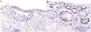 Los melanocitos dendríticos neoplásicos son positivos con las inmunorreacciones para melan-A (a) y para HMB-45 (b) (20×).