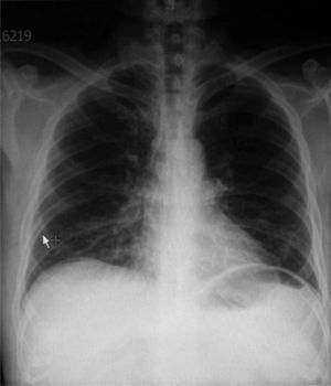 Radiografía de tórax anteroposterior dentro de parámetros normales.
