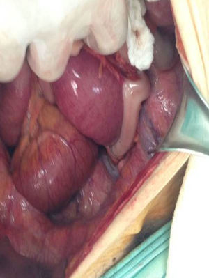 Hernia del agujero obturador de intestino delgado a 130cm del ángulo de Treitz.
