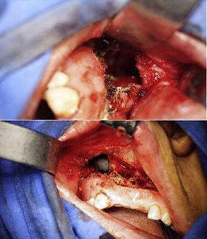 El abordaje sublabial permite el acceso al antro maxilar. Por medio de un retractor se visualizó incluso la pared posterior del seno maxilar, exponiendo la lesión y permitiendo su resección total.