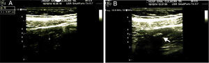 Ultrasonido de abdomen. A) Imagen compatible con proceso inflamatorio apendicular agudo. B) Imagen hiperecogénica con sombra acústica y presencia de apendicolito en su interior (flecha).