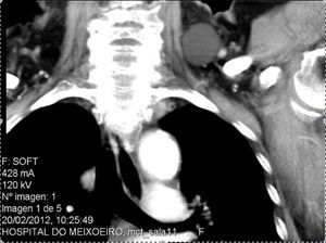 Tomografía computada cervicotorácica, corte frontal. Se aprecia lesión quística ovoidea en región supraclavicular izquierda.