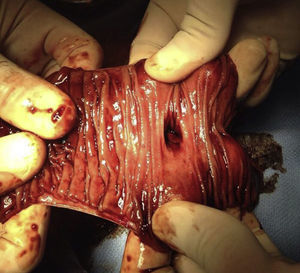 Pieza quirúrgica abierta que muestra la superficie intraluminal del divertículo.