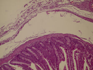 Tinción con H/E. Porción superficial: epitelio con lámina propia y muscularis mucosae. Porción profunda: muscular propia atrófica o ausente.
