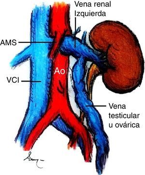 Esquema que representa la compresión de la vena renal izquierda entre la arteria mesentérica superior y la aorta, que produce ectasia, tortuosidad de la VRI y gonadal (testicular u ovárica).AMS: arteria mesentérica superior; Ao: aorta; VCI: vena cava inferior.