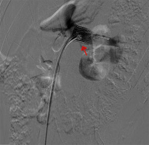 Angiografía que demuestra la colocación exitosa del stent expandible por balón (flecha roja) y la restauración del flujo de la vena renal izquierda a la vena cava inferior. La hematuria se resolvió progresivamente después de la colocación del dispositivo endovascular.