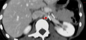 Angiotomografía abdominal (corte axial) a un año del procedimiento, que demuestra el sitio del stent, así como la permeabilidad y descompresión de la vena renal izquierda.