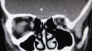 Tomografía computada posquirúrgica. Corte coronal.