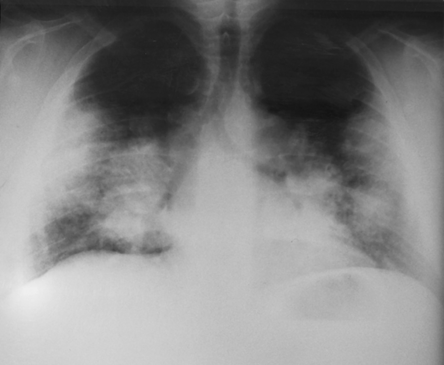 Varón de 27 años con infiltrados pulmonares bilaterales y parotiditis ...