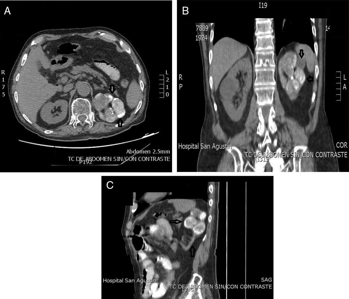 Riñón mastic | Revista Clínica Española