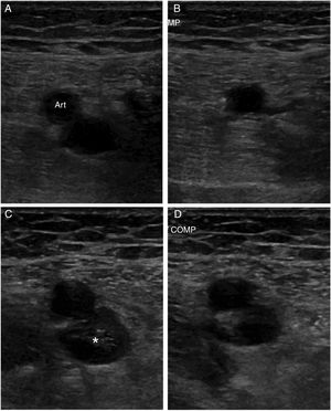 A) Vena femoral normal sin compresión. B) Vena femoral normal con compresión, que la colapsa completamente. C) Imagen de trombosis venosa con material ecogénico en el interior de la vena. D) Falta de compresibilidad. Fuente: Imagen obtenida de Neddleman et al.27.