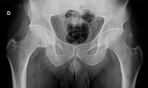 Alteraciones articulares en un paciente con síndrome de Stickler. Se observan cambios degenerativos en la articulación coxofemoral derecha, con pinzamiento de la interlínea articular, esclerosis subcondral, osteofitos y ligera deformidad de la cabeza femoral.