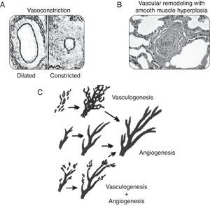 Pathogenesis of PPHN syndrome: vasoconstriction (A), vascular remodeling (B), angiogenesis, and vasculogenesis (C).