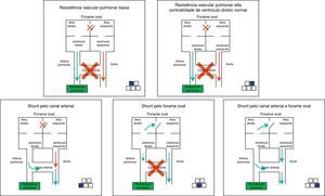 Presence or absence of right-to-left shunt in relation to vascular resistance in PPHN syndrome.