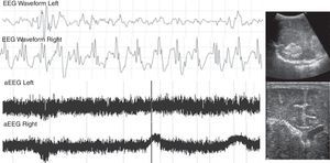 Patient with severe pulmonary hypertension secondary to a dilated cardiomiopathy with heart failure. On the third day of life, the aEEG showed seizures in the right hemisphere. Due to clinical suspicion, a head ultrasound was performed, showing intraventricular hemorrhage in the right side of the brain. aEEG, amplitude-integrated electroencephalography.