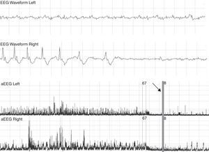 Patient with a suppressed pattern of aEEG evolves to status epilepticus. He was treated with 60mg/kg of phenobarbital without effects on seizures. The arrow shows how seizures are controlled with phenitoin, and base line becomes more suppressed. aEEG, amplitude-integrated electroencephalography.