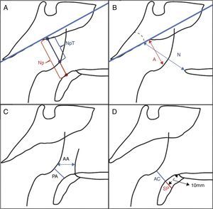 Illustration of the quantitative parameters. (A) NpT, nasopharyngeal tonsil; Np, nasopharynx. (B) A, adenoid; N, nasopharyngeal space. (C) AA, antroadenoid; PA, palatal airway. (D) AC, air column; SP, soft palate.