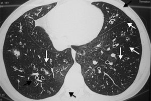 Computed tomography images of an adolescent cystic fibrosis patient's chest, showing mucoid impaction (black arrows) and bronchiectasis (white arrows).