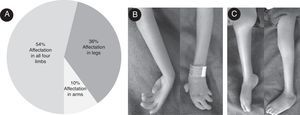 General characteristics of the patients with arthrogryposis multiplex congenita (AMC) studied. (A) Percentage of involvement of limbs. (B) Upper limbs from an affected patient; forearm pronosupination movements were not possible, wrists and interphalangeal joints were fixed in semi-flexion position and no flexion creases were observed. (C) Lower limbs of a patient with AMC; right and left knees were fixed in semi-flexion and extension position respectively, right ankle was extended and the left ankle in adduction.