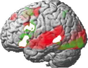 The left frontoparietal network of regions for listening and reading (red: listening; green: reading; white: overlap).