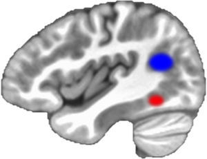 The visual word form area (red circle) and the temporoparietal region (blue circle): brain markers of reading development.