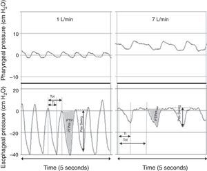 Simultaneous recordings of pharyngeal (top) and esophageal (bottom) pressures from an infant receiving 1L/min (left) and 7L/min (right) through a nasal cannula. Although there is a notable increase in pharyngeal pressure during higher flow conditions, virtually no increase is observed in end-expiratory pressure measured at the thoracic level. The application of 7L/min flow significantly decreased the intrathoracic pressure swings through an attenuation of the negative inspiratory pressure. Adapted from Milési et al.15