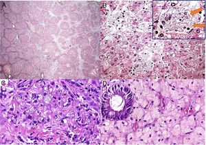 Some histological aspects of liver and duodenum in patient 4. (A) An advanced micronodular cirrhosis observed in the liver explant (H&E, 25×); (B) This field (of the liver explant) depicts microvesicular and mediovesicular steatosis in many hepatocytes and groups of enlarged xanthomatous Kupffer cells in sinusoids (H&E, 200×), in addition to rare needle-shaped clefts (arrows) inside Kupffer cells in the inset; (C) Many portal tract macrophages exhibit xanthomatous cytoplasm in the liver graft after 7 years of liver transplantation (H&E, 400×); (D) The lamina propria is intensely infiltrated by large lipid-laden foam cells in this duodenal biopsy (H&E, 400×).