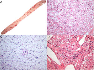 Histological aspects of the liver biopsy in patient 7. (A) Marked bridging fibrosis with occasional nodules (Picrosirius red stain, 25×); (B) Mediovesicular steatosis (a small-droplet variant of the macrovesicular steatosis) and hepatocytes with pale cytoplasm (H&E, 400×); (C) Only rare microvacuolated Kupffer cells identified, which were slightly stained with PASD (PAS after diastase digestion, 400×); (D) Some macrophages with foamy, tan-colored cytoplasm were detected in portal tracts (H&E, 400×).