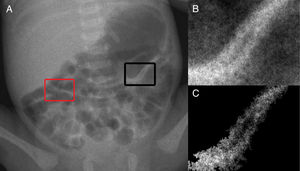(A) abdominal radiograph with intestinal pneumatosis (IP) identified in the region of interest (ROI) circumscribed by the black box. Normal bowel loop is also identified in the ROI circumscribed by the red box in the same radiography; (B) highlight of ROI containing an IP-suspicious loop; (C) region of interest after segmentation of Fig. 3B based on region growing technique, which results in the extraction of the IP loop from background. ROIs, regions of interest.