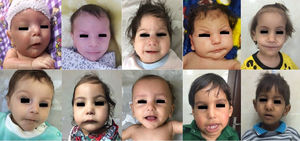 The facial appearance of 10 patients with hypoparathyroidism, dysmorphism, and molecular confirmation of Sanjad–Sakati syndrome in southwest Iran. Note: the small, deep-set eyes, thin upper lip, and long philtrum.
