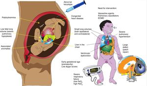 Factors associated with poor prognosis in congenital diaphragmatic hernia (CDH). Antenatal factors such as low fetal lung volume, associated anomalies (especially cardiac), polyhydramnios, abnormal karyotype, and liver in the chest can be associated with lower survival. Postnatal factors associated with severe pulmonary hypertension (low PaO2), lung hypoplasia (high PaCO2), large defect requiring patch repair, ventricular dysfunction, and need for vasoactive agents and/or ECMO are associated with higher mortality. Copyright Satyan Lakshminrusimha.