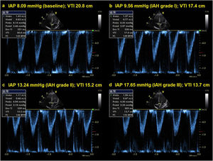 Doppler echocardiographic examination performed during the abdominal compression maneuver. A progressive reduction in aortic velocity-time integral occurs as abdominal pressure increases. IAP, intra-abdominal pressure; IAH, intra-abdominal hypertension; VTI, aortic velocity-time integral.