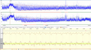 An example of how seizures appear on aEEG and raw EEG. [Authors