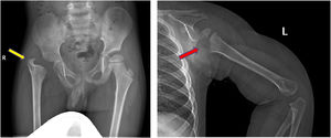 Sequelae of hip and shoulder in the follow-up. a, AP radiograph of the pelvis demonstrating severe deformity of the hip, including complete loss of femoral head and neck with no articulation of the hip, limb-length discrepancy and acetabular dysplasia (yellow arrow). b, Lateral-view radiograph of humerus showing the epiphysis of the proximal humerus are partially absent (red arrow).