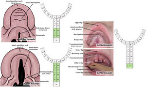(Left) Schematic drawings illustrating cleft palate deformities, encompassing instances featuring (Left, top) solely the soft palate, (Left, bottom) both the soft and hard palates, and (Right) an overt submucous cleft palate deformity. These deformities are categorized using Noordhoff