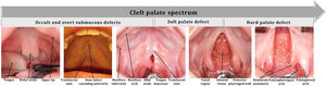 Intraoral images displaying the spectrum of isolated cleft palate deformity, highlighted by a gray arrow to indicate the escalating severity of abnormalities. Tongue depressors assist in gently retracting the tongue, providing a broader intraoral view. Simultaneously, direct lighting helps to illuminate the intraoral space, ensuring adequate brightness and contrast to observe the specific details of the palatal structures. Courtesy of Rafael Denadai, M.D.