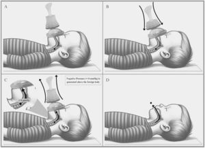 Sequential steps for airway obstruction relief using the LifeVac® device in a pediatric patient. Fig. 1 shows the sequence of using of the LifeVac® device to clear airway obstruction in a child. (A) Positioning the device over the child