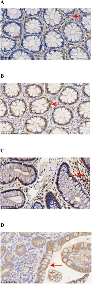 Immunohistochemical Staining Results of GPX4 and PTGS2 in CD and Normal Colonic Tissues. (A) GPX4 showed weak positive expression in CD colonic tissues, characterized by light color and few granules. (B) PTGS2 showed strong positive expression in CD colonic tissues, characterized by many brownish-yellow or brown granules. (C) GPX4 showed strong positive expression in normal colonic tissues, characterized by many brownish-yellow or brown granules. (D) PTGS2 showed weak positive expression in normal colonic tissues, characterized by light color and few granules.