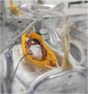 Application of hammock positioning (source: authors’ collection).