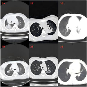Findings on chest computed tomography before and after BAL. (1A) Case 1 (pre-BAL). (1B) Case 1 (2 weeks post-BAL). (2A) Case 2 (pre-BAL). (2B) Case 2 (1 week post-BAL). (3A) Case 3 (pre-BAL). (3B) Case 3 (2 weeks post-BAL). BAL, bronchoalveolar lavage