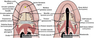 Schematic drawings illustrating the (Left) normal anatomy of the palate and (Right) the abnormal anatomy in an isolated cleft palate deformity. (Right) The cleft muscle mass (including the levator muscle) runs almost parallel with the cleft margin before it inserts aberrantly into the posterior border of the hard palate. The anterior tendinous fibers of the tensor attach to the lateral aspect of the posterior edge of the hard palate. The aberrant positioning of the cleft muscle mass, along with an abnormal fusion with the tendon of the tensor muscle, is believed to impair the function of the tensor muscle in assisting with Eustachian tube function. The aberrantly inserted cleft muscle mass results in ineffective contraction and an inability to close the palate against the posterior pharyngeal wall. Courtesy of Rafael Denadai, M.D.